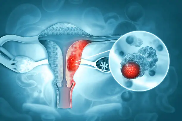 Cervical Cancer क्या है? महिलाओं के लिए समय पर जांच क्यों ज़रूरी है